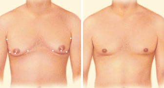 Male Breast Reduction surgery in bangalore